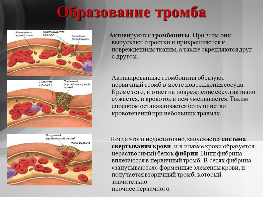 Условиях и крови в. Образование тромбов в крови. Процесс образования тромба. Тромбоциты образуют тромб.