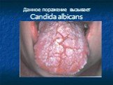 Данное поражение вызывает Candida albicans