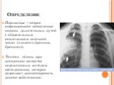 Определение. Пневмония – острое инфекционное воспаление нижних дыхательных путей с обязательным вовлечением легочной ткани (альвеол, бронхов, бронхиол). Рентген лёгких при пневмонии является незаменимым методом исследования, которое позволяет диагностировать данное заболевание.