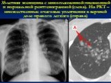 35-летняя женщина с микоплазменной пневмонией и нормальной рентгенограммой (слева). На РКТ – множественные очаговые уплотнения в верхней доле правого легкого (справа)