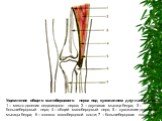 Ущемление общего малоберцового нерва под сухожилием двуглавой м-цы 1 – место двоения седалищного нерва; 2 – двуглавая мышца бедра; 3 – большеберцовый нерв; 4 – общий малоберцовый нерв; 5 – сухожилие двуглавой мышцы бедра; 6 – головка малоберцовой кости; 7 – большеберцовая кость.