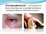 Електроофтальмія — це ураження очей унаслідок дії ультрафіолетового випромінювання електричної дуги.
