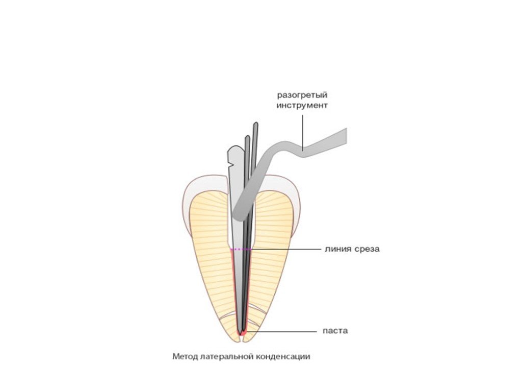 Пломбирование корневых каналов презентация