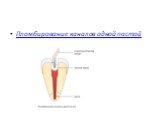 Пломбирование каналов одной пастой