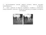 А— рентгенограмма моляра нижней челюсти, каналы которого запломбированы серебряными штифтами. В — после удаления из каналов серебряных штифтов и повторного эндодонтического лечения с обтурацией каналов гуттаперчей отмечается регенерация.