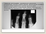 Прицельная рентгенография проксимальных и дистальных межфаланговых суставов в прямой проекции. Множественные остеофиты. В разной степени выраженности сужение суставных щелей. Множественные кисты со склеротическим ободком. Субхондральный остеосклероз 2-го проксимального и 3-го дистального межфалангов