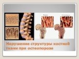 Нарушение структуры костной ткани при остеопорозе
