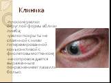 Клиника. -плоские узелки округлой формы вблизи лимба; -узелки покрыты не спаянной с ними гиперемированной конъюнктивой с фиолетовым оттенком; -не сопровождается выраженным покраснением глаза или болью.