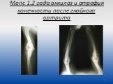 Мопс 1.2 года анкилоз и атрофия конечности после гнойного артрита