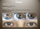 Глаза. Анофтальмия Микроофтальмия - Структурные дефекты глаз Катаракта Сенсорный нистагм Пробковая потеря зрения и гипоплазия зрительного нерва; Колобома радужки
