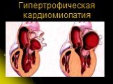 Гипертрофическая кардиомиопатия Слайд: 6