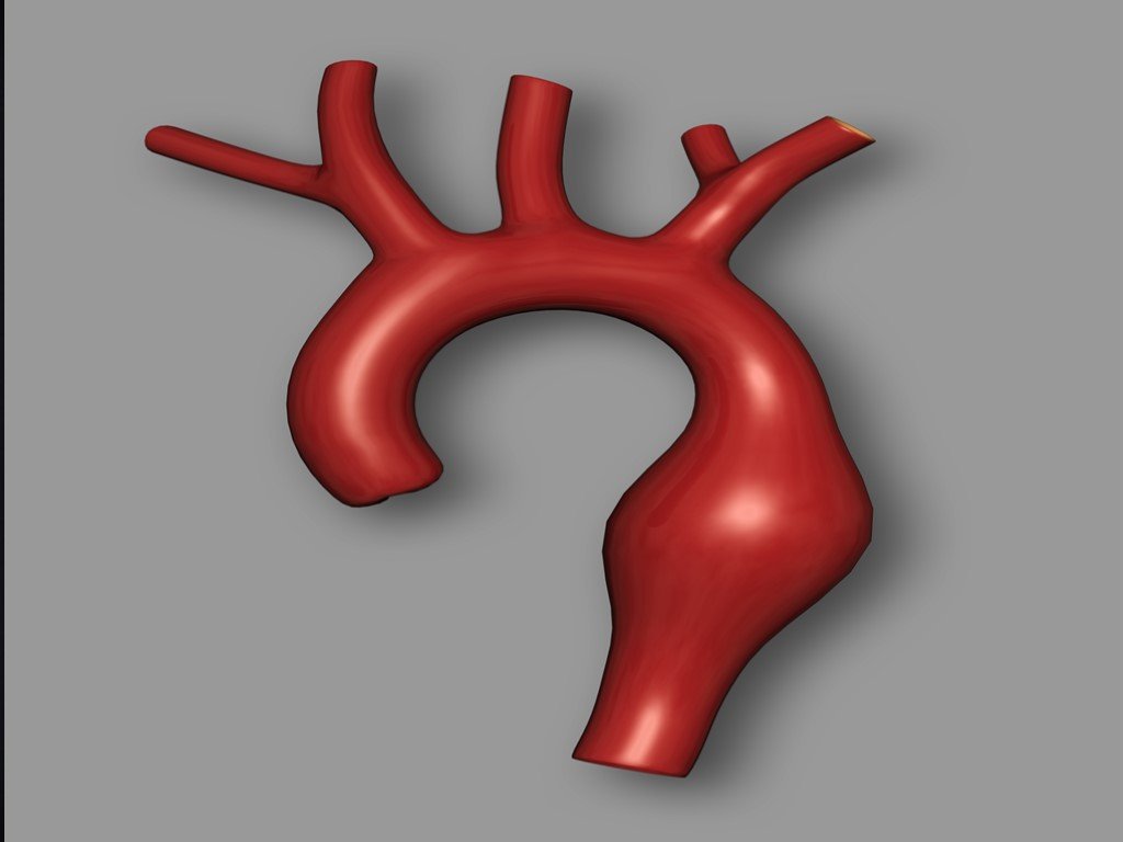 Аневризма аорты что это. Мешковидная аневризма дуги аорты. Аневризматическое расширение аорты. Мешотчатая аневризма дуги аорты. Веретеновидная аневризма грудной аорты.