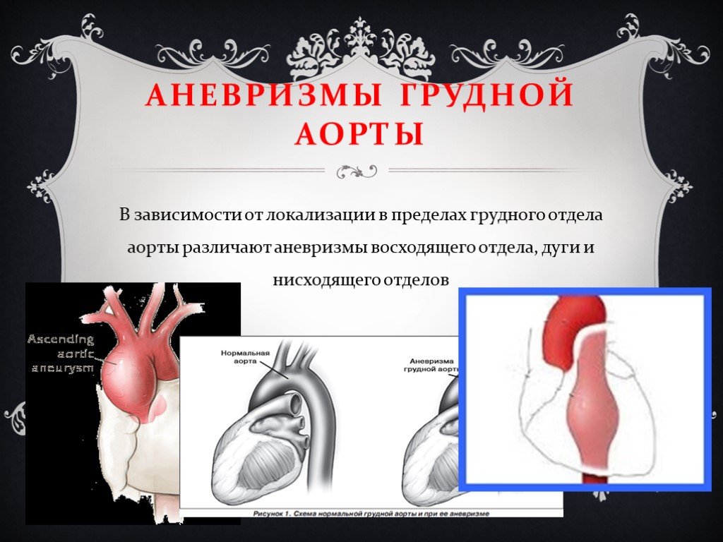 Аневризмы аорты презентация