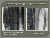 Рентгенограмма при анаэробной инфекции. Перистый рисунок или рисунок ёлочки. Пчелиные соты