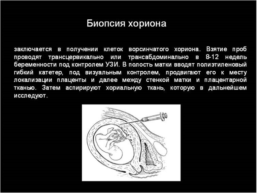 Биопсия ворсин хориона. Биопсия ворсин хориона сроки проведения. Трансцервикальная биопсия ворсин хориона. Биопсия хориона показания.