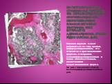 По гистологическому строению рак гортани в 98% случаев представлен ороговевающим или неороговевающим плоскоклеточным эпителием; реже встречается аденокарцинома, крайне редко саркома (0,4%). Раковая опухоль может развиваться по типу зрелой, дифференцированной, что относится к ороговевающим формам, и 