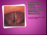 К облигатному предраку гортани относят Различные формы дисплазии гортани (лейкоплакия, лейкокератоз). На рисунке: Лейкоплакия обеих голосовых складок.