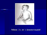 Ребенок 2-х лет с фенилкетонурией