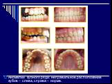 Аномалии зубного ряда: неправильное расположение зубов – слева, справа – норма.