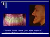 Нарушения прикуса: Прогения - зубы нижней челюсти при смыкании перекрывают одноимённые зубы верхней челюсти