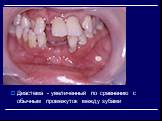 Диастема - увеличенный по сравнению с обычным промежуток между зубами