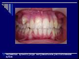 Аномалии зубного ряда: неправильное расположение зубов