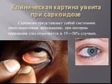 Клиническая картина увеита при саркоидозе. Саркоидоз представляет собой системное гранулематозное заболевание, при котором поражение глаз отмечается в 15—38% случаев.