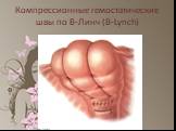 Компрессионные гемостатические швы по В-Линч (B-Lynch)