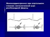 Фонокардиограмма при аортальном стенозе: систолический шум ромбовидной формы