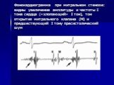 Фонокардиограмма при митральном стенозе: видны увеличение амплитуды и частоты I тона сердца («хлопающий» I тон), тон открытия митрального клапана (М) и предшествующий I тону пресистолический шум