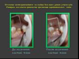 Иссечение кости производится на глубину 3мм ниже уровня уступа зуба. Контроль мы можем произвести при помощи пародонтального зонда. До иссечения костной ткани. После иссечения костной ткани