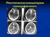 Рентгеновская компьютерная томография мозга: