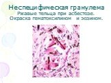 Неспецифическая гранулема Ржавые тельца при асбестозе. Окраска гематоксилином и эозином.