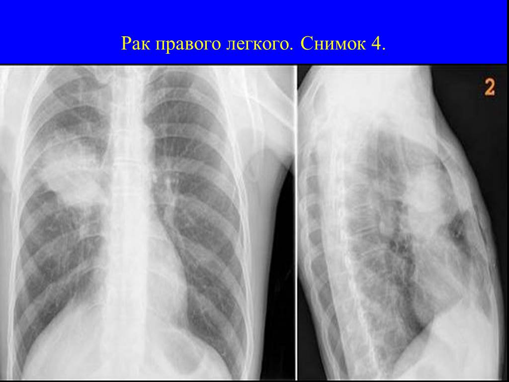 Рак центрального правого. Снимок легких. Опухоль в легких на рентгене. Новообразование в легких. Опухоль легкого на рентгене.