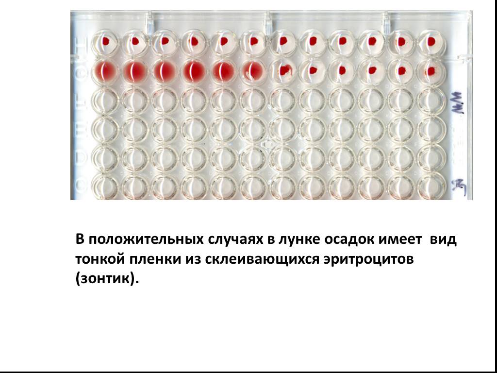 В случае положительного. РПГА шигеллез. Реакция РНГА микробиология. Серологическая реакция РНГА. РНГА микробиология.