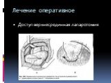 Лечение оперативное. Доступ верхнесрединная лапаротомия