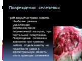 Повреждения селезенки. 30% закрытых травм живота. Наиболее ранима увеличенная селезенка,после перенесенной малярии, при портальной гипертензии. Повреждение селезенки возможно при травмах любого отдела живота, но чаще после удара в эпигастральную область или в проекции селезенки