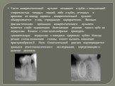 Часто конкрементозный пульпит возникает в зубах с повышенной стираемостью твердых тканей, либо в зубах, леченных в прошлом по поводу кариеса , конкрементозный пульпит обнаруживается у лиц, страдающих пародонтозом. Важным диагностическим признаком конкрементозного пульпита является слабо выраженная б