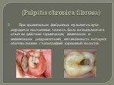 (Pulpitis chronica fibrosa). При хроническом фиброзном пульпите в зубе ощущается постоянная тяжесть. Боль же появляется в ответ на действие термических, химических и механических раздражителей, интенсивность которых обычно связана с топографией кариозной полости.