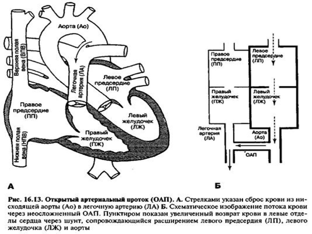 Оап у новорожденных. Открытый артериальный проток на ЭХОКГ. Открытый артериальный проток у новорожденных. Боталлов проток схема. Боталлов проток гемодинамика.