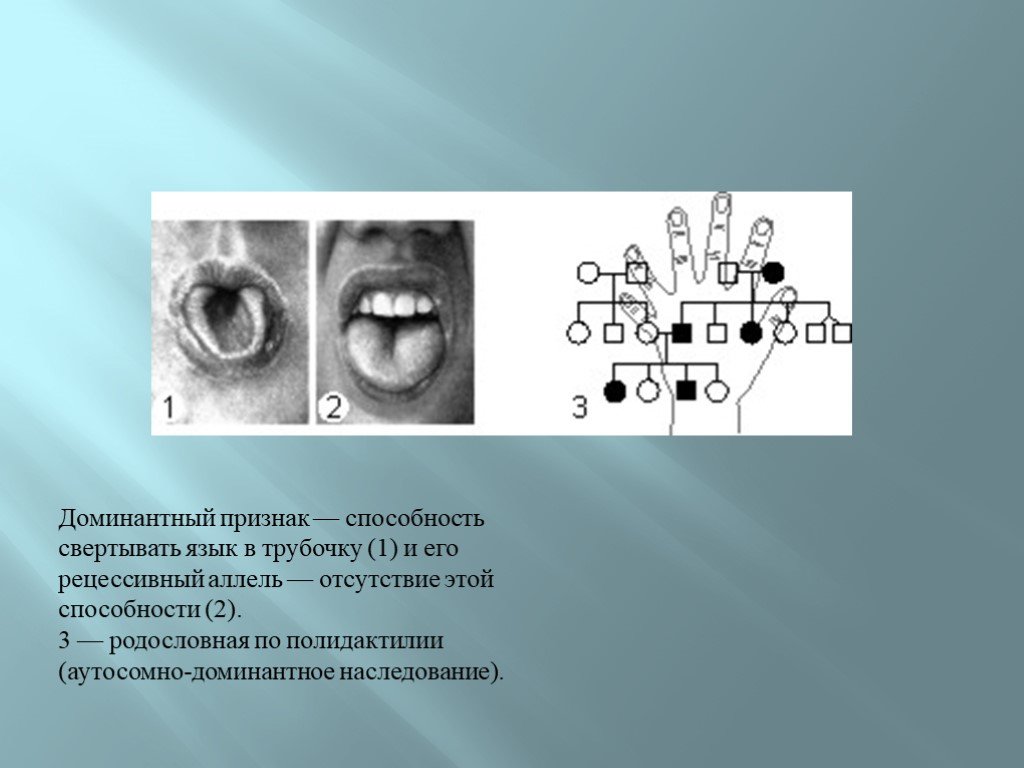 Отсутствие малых коренных зубов наследуется как доминантный признак гипертрихоз