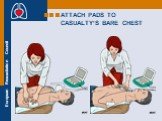 ATTACH PADS TO CASUALTY’S BARE CHEST