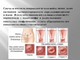 Сначала опухоль повреждает только шейку матки, затем постепенно начинает прорастать окружающие органы и ткани. В ходе заболевания опухолевые клетки могут переноситься с током лимфы в расположенные неподалеку лимфатические узлы и образовывать там новые опухолевые узлы (метастазы).