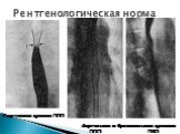 Рентгенологическая норма. Гортанное сужение ППП. Аортальное и бронхиальное сужения ППП ПКП