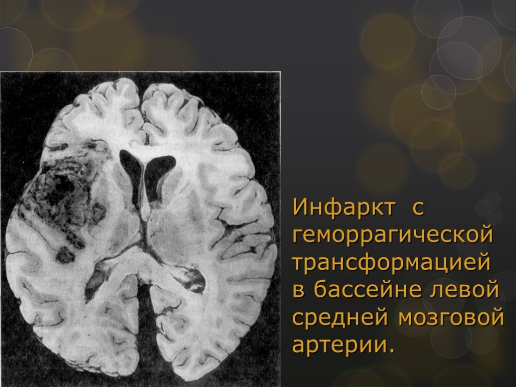 Инсульт в бассейне мозговой артерии. Инфаркт в бассейне средней мозговой артерии. Инфаркт головного мозга в бассейне левой средней мозговой артерии. ОНМК В бассейне левой средней мозговой. Инсульт в бассейне средней мозговой артерии.