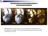 Компьютерная томография сердца и коронарных артерий. Заключение: КТ-картина хронического перикардита, гемодинамически значимого стеноза ПКА – 90%, гипертрофии миокарда ПЖ с обструкцией выходного тракта ПЖ.