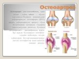 Остеоартроз. Остеоартро́з (лат.osteoarthrosis, грек. osleon — сүйек, arthron — «буын» мағынасын білдіреді; (синонимдері: деформирлеуші остеоартроз (ДОА), артроз, деформирлеуші артроз) —буын беткейлерінің шеміршек тіндерінің зақымдануынан дамитын, буынның дегенеративті - дистрофиялық ауруы. Бұл ауруд