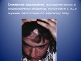 Снижение оволосения, выпадение волос в подмышечных впадинах, на голове и т. п., у мужчин оволосение по женскому типу.