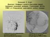 Больной С. 9 лет. Диагноз: Инфаркт мозга в бассейне левой передней мозговой артерии. Гипоплазия ВСАs. ПМК I ст. Нарушение циркадного ритма сердца. Гипоплазия ВСАs с образованием развитого каротидно-офтальмического анастомоза. При проведении правосторонней каротидной ангиографии контрастируется СМАs 