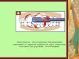 . Заканчивается чистка круговыми массирующими движениями по наружной поверхности зубов, захватывая зоны десен для улучшения кровообращения.